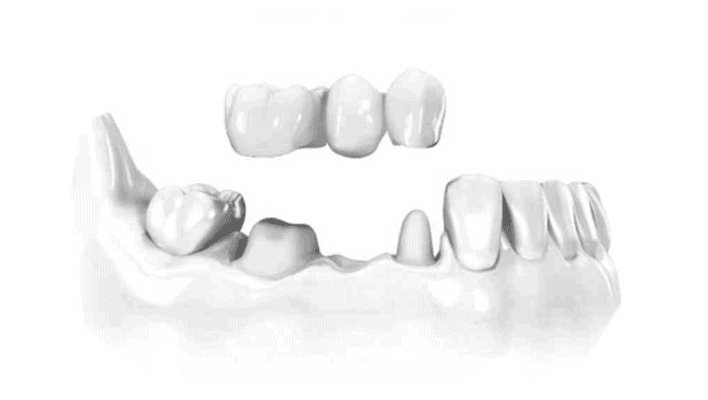 Protesi Dentali Fisse su Denti Naturali