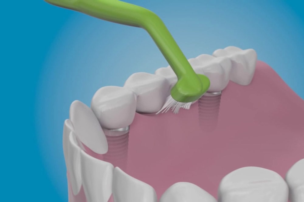 Come prenderti cura degli impianti dentali