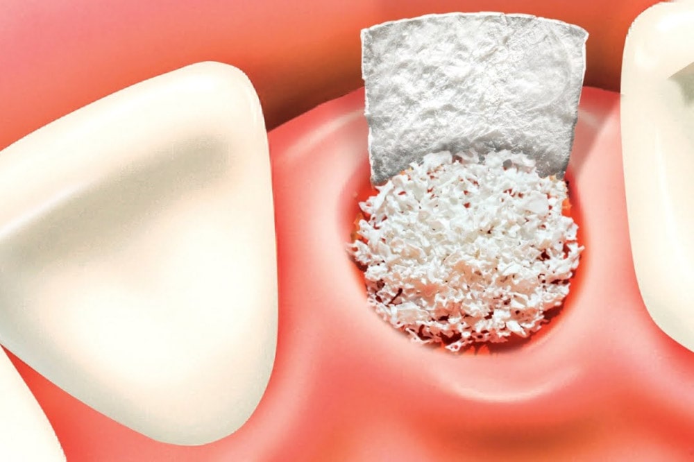 L’innesto osseo per gli impianti dentali