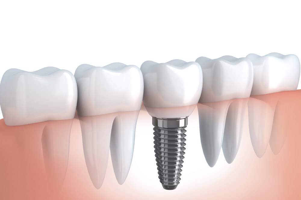 Come ottenere il massimo dai tuoi impianti dentali