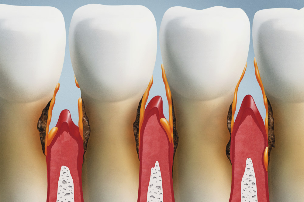 Denti che si muovono