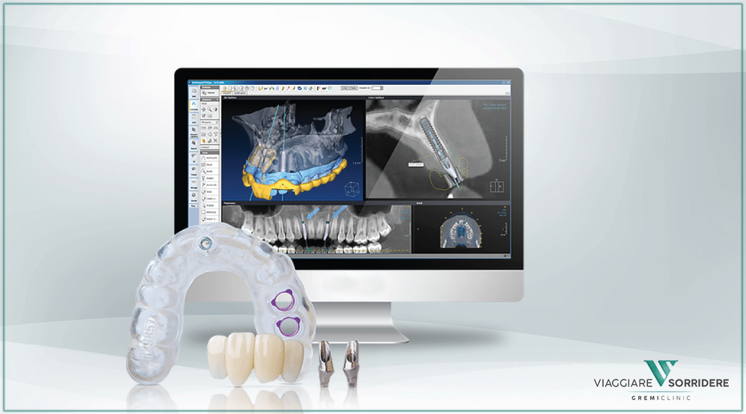 Implantologia guidata