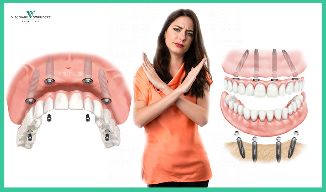 Denti fissi su 4 impianti